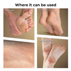 Winston Callus Remover - Image 3